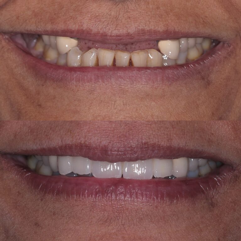Anterior Implants before and after