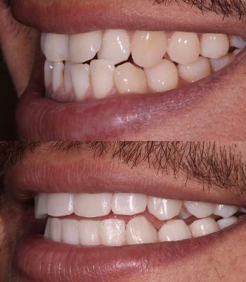 Invis whitening bonding